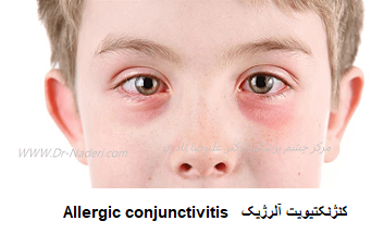 کنژنکتیویت آلرژیک Allergic conjunctivitis