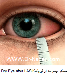 Dry Eye after LASIK خشکی چشم بعد از لیزیک 