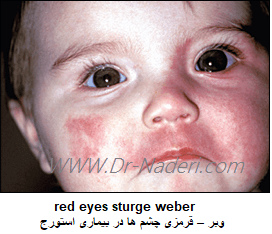 قرمزی چشم ها در بیماری استورج – وبر red eyes sturge weber
