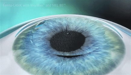 Laser vision correction اصلاح بینایی با لیزر