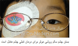 Amblyopia treatment درمان تنبلی چشم