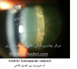 Anterior Subcapsular cataract آب مروارید زیر کپسول قدامی 