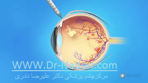 .Avastine injection for treatment of macular edema تزریق آواستین در درمان ورم ماکولا 