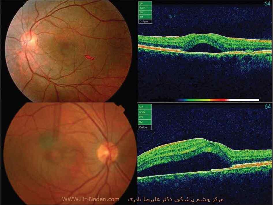 نمای افتالموسکوپی و OCT در فرد مبتلا به CSR