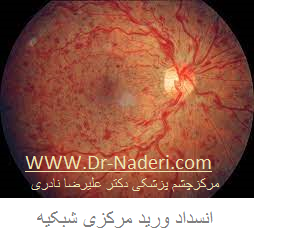 Centeral Retinal Vein Occlosion CRVO انسداد ورید مرکزی شبکیه
