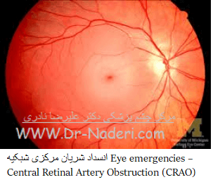  Central retinal artery occlussion (CRAO) انسداد شریان مرکزى شبکیه