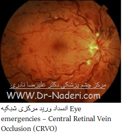  (CRVO)یا (Central Retinal Vein Occlusion) انسداد ورید مرکزى شبکیه 