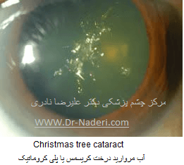 آبم روارید درخت کریسمس یا پلی کروماتیک Christmas tree cataract