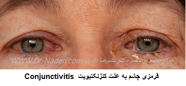  Conjunctivitis  قرمزی چشم به علت کنژنکتیویت