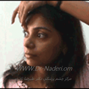 Soft Contact lens گذاشتن لنز تماسی نرم