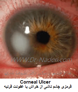 قرمزی چشم ناشی از خراش یا عفونت قرنیه Corneal Ulcer