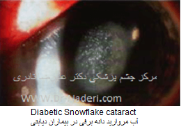 آب مروارید دانه برفی در بیماران دیابتی Diabetic Snowflake cataract
