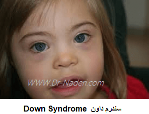  Down Syndrome سندرم داون