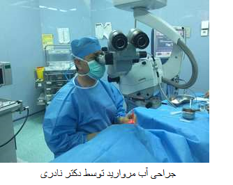 dr naderi cataract surgery عمل جراحی آب مروارید توسط دکتر نادری