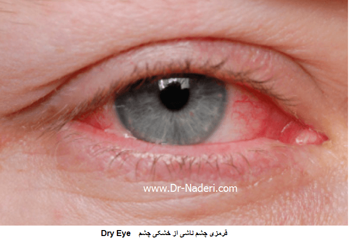 Dry eye خشکی چشم