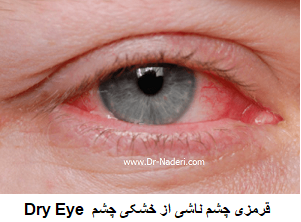 Dry Eye قرمزی چشم ناشی از خشکی چشم