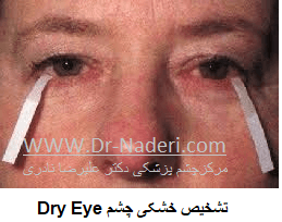  Dry Eye تشخیص خشکی چشم