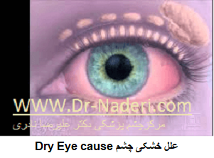  Dry Eye causeعلل خشکی چشم