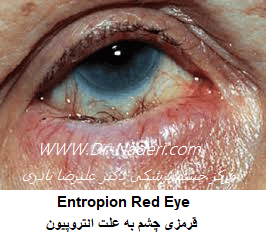  Entropion Red Eye  قرمزی چشم به علت انتروپیون