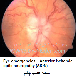 Eye emergencies - Anterior ischemic optic neuropathy (AION)سکته عصب چشم 