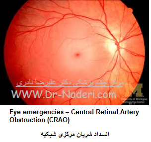  Eye emergencies - Central Retinal Artery Obstruction (CRAO) انسداد شریان مرکزی شبکیه