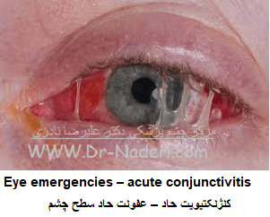  Eye emergencies  acute conjunctivitisعفونت حاد سطح چشم   کنژنکتیویت حاد