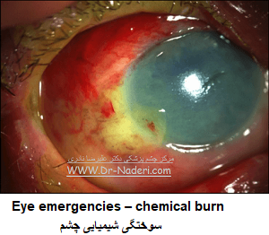 Eye emergencies – chemical burnسوختگی شیمیایی چشم