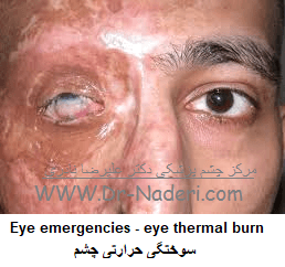  Eye emergencies - eye thermal burn سوختگی حرارتی چشم
