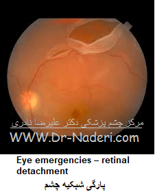  Eye emergencies - retinal detachmentپارگی شبکیه چشم