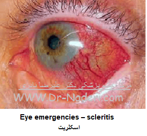  Eye emergencies - اسکلریت