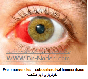  Eye emergencies - subconjunctival خونریزی زیر ملتحمه