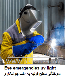   Eye emergencies uv lightسوختگی سطح قرنیه به علت جوشکاری