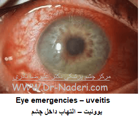 Eye emergencies - uveitis التهاب داخل چشم - یووئیت