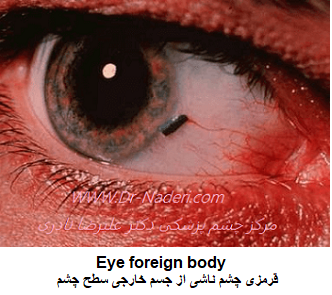 قرمزی چشم ناشی از جسم خارجی سطح کره چشم