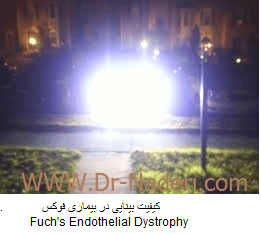 کیفیت بینایی در بیماری فوکس Fuch's Endothelial Dystrophy
