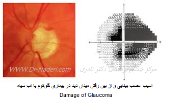  Damage of Glaucoma آسیب گلوکوم یا آب سیاه