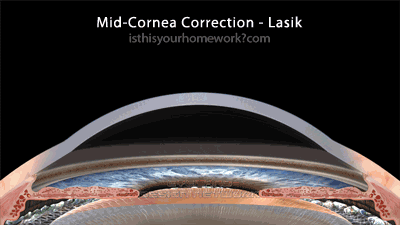 LASIK eye surgery جراحی لیزیک چشم
