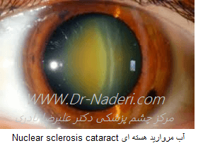 Nuclear sclerosis cataract آب مروارید هسته ای 