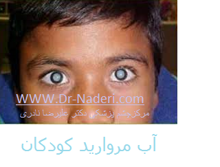 pediatric Cataract آب مروارید کودکان