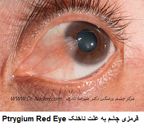  Ptrygium Red Eye قرمزی چشم به علت ناخنک