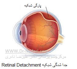 جدا شدگی شبکیه Retinal Detachment 