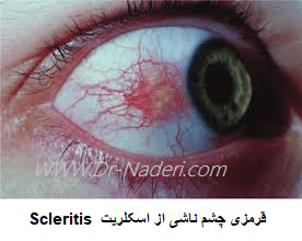 قرمزی چشم ناشی از اسکلریت Scleritis