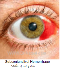 خونریزی زیر ملتحمه Subconjunctival Hemorrhage 