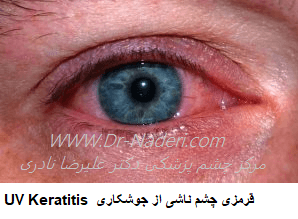 قرمزی چشم ناشی از جوشکاری UV Keratitis