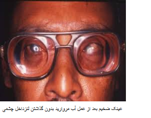 aphakia glasses عینک ضخیم در عمل اب مروارید بدون کار گذاری لنز 