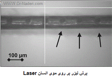 Laser لیزر