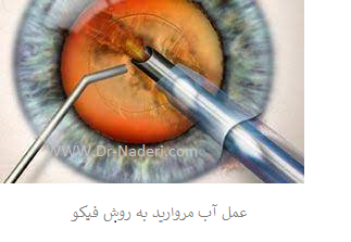 cataract surgery phacoemulsification عمل آب مروارید به روش فیکو