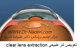  clear lens extraction تعویض لنز طبیعی