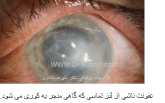 contact lenses infection عفونت ناشی از لنز تماسی 