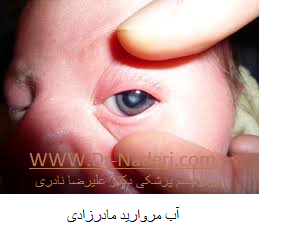 congenital cataract آب مروارید مادرزادی